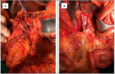 Case report: Candidiasis of gastrojejunostomosis after pancreaticoduodenectomy: Preliminary experience from two cases